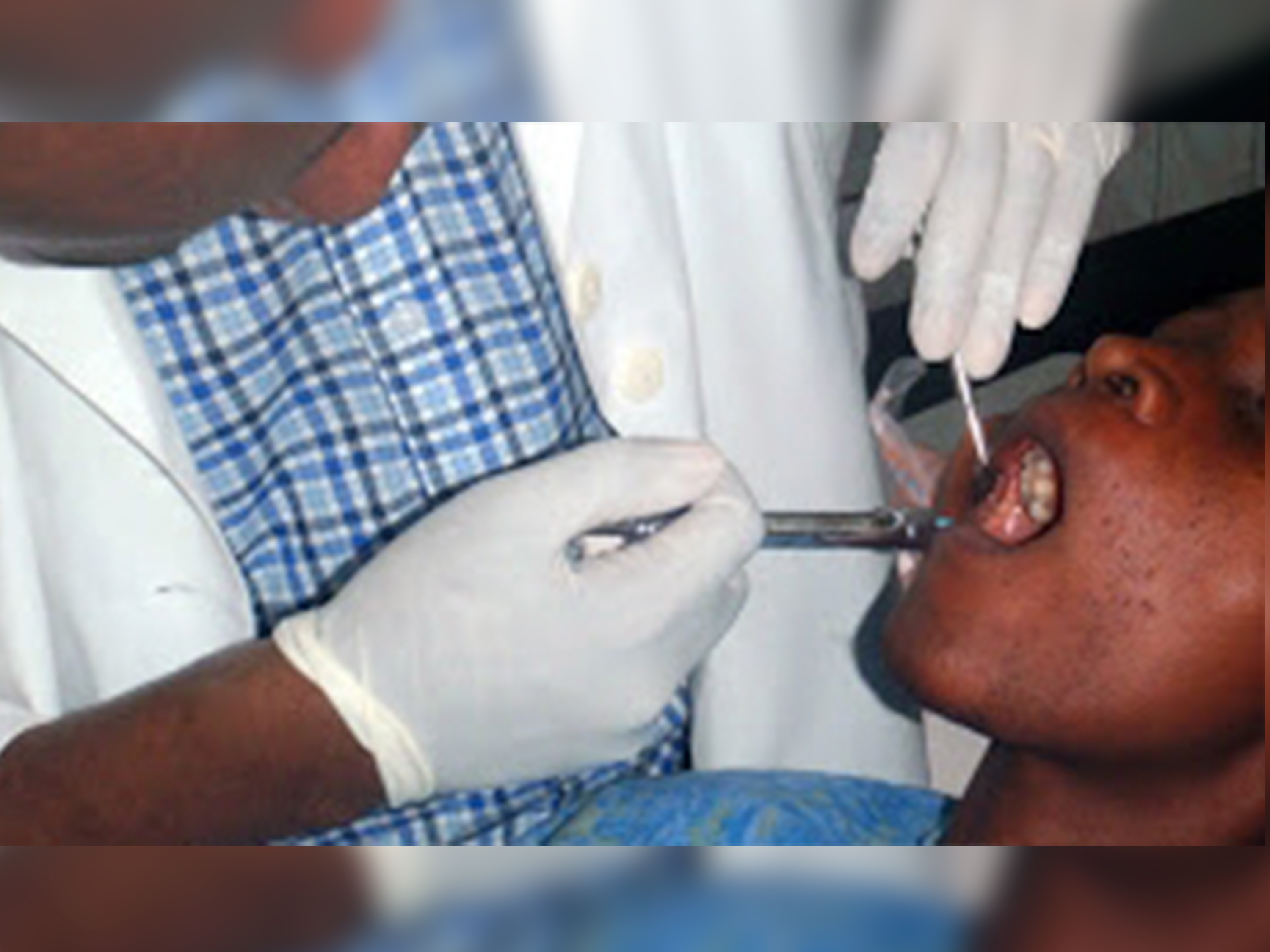Le défaut de soins bucco-dentaires touche près de la moitié de la population mondiale