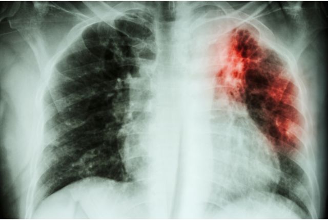 L’ONU et les Etats membres s’engagent à mettre fin à la tuberculose