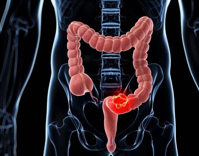 Autour du cancer colorectal