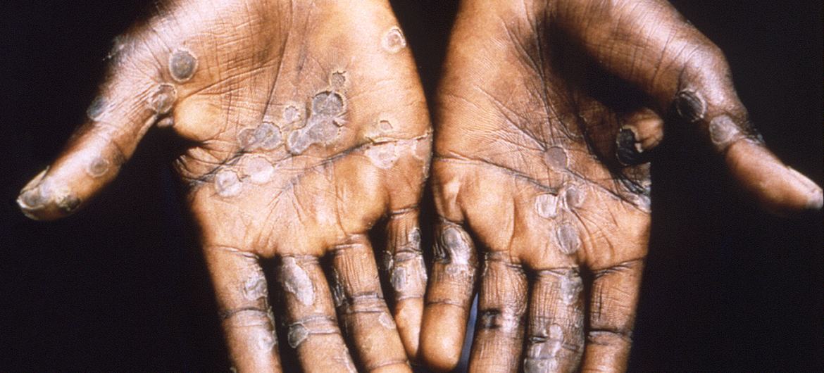Le Mpox n’est pas le nouveau Covid-19 mais le monde doit lutter contre lui ensemble sur tous les continents (OMS)