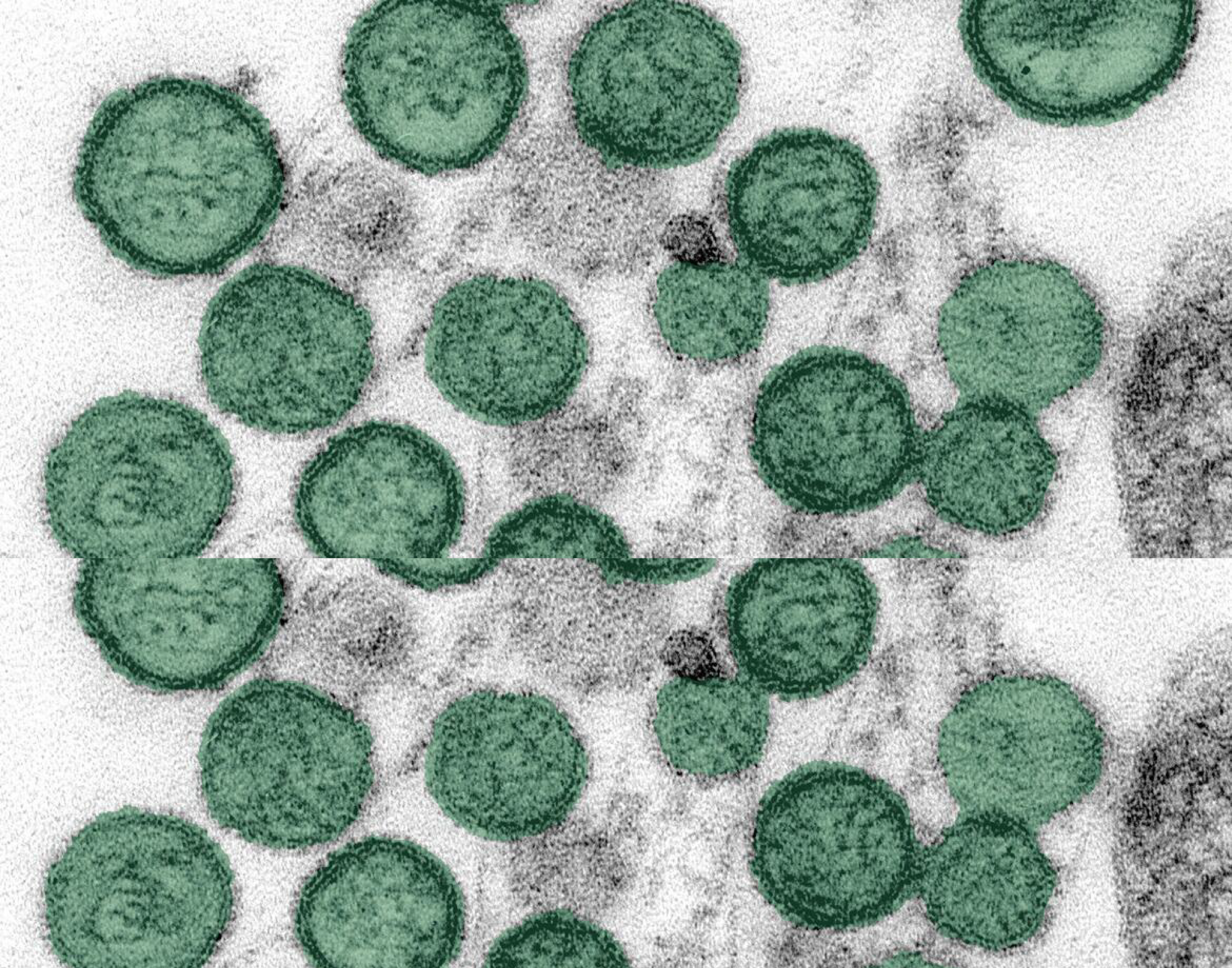 Hantavirus : un cas confirmé en Suisse, la souche des Andes identifiée chez au moins 3 patients